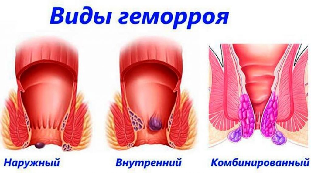 Геморрой Фото Что Делать